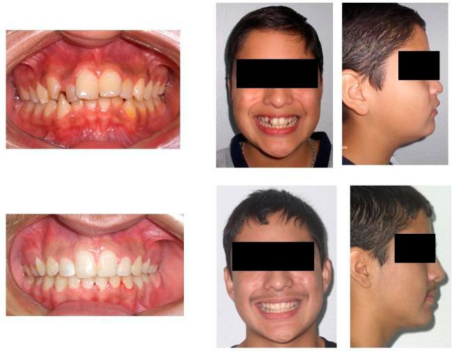 https://dentalreynosa.com/wp-content/uploads/2022/04/ortodoncia-caso2-2.jpg