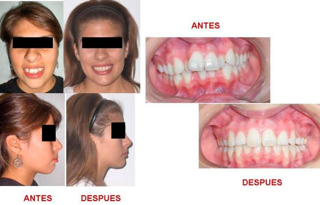 https://dentalreynosa.com/wp-content/uploads/2022/04/ortodoncia-caso2-3.jpg