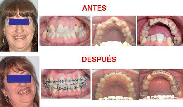 https://dentalreynosa.com/wp-content/uploads/2022/04/ortodoncia-caso2.jpg
