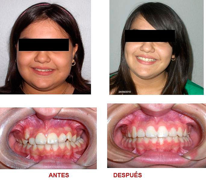 https://dentalreynosa.com/wp-content/uploads/2022/04/ortodoncia-caso3-1.jpg