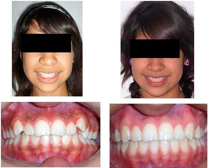 https://dentalreynosa.com/wp-content/uploads/2022/04/ortodoncia-caso3-2.jpg