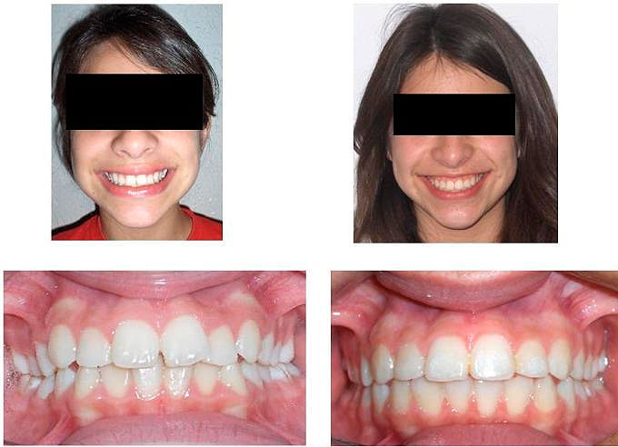 https://dentalreynosa.com/wp-content/uploads/2022/04/ortodoncia-caso3-3.jpg