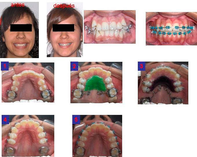 https://dentalreynosa.com/wp-content/uploads/2022/04/ortodoncia-caso3-4.jpg