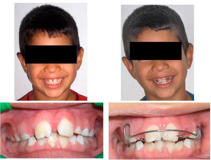https://dentalreynosa.com/wp-content/uploads/2022/04/ortodoncia-caso4-1.jpg