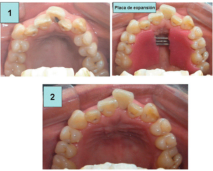 https://dentalreynosa.com/wp-content/uploads/2022/04/ortodoncia-caso4-2.jpg