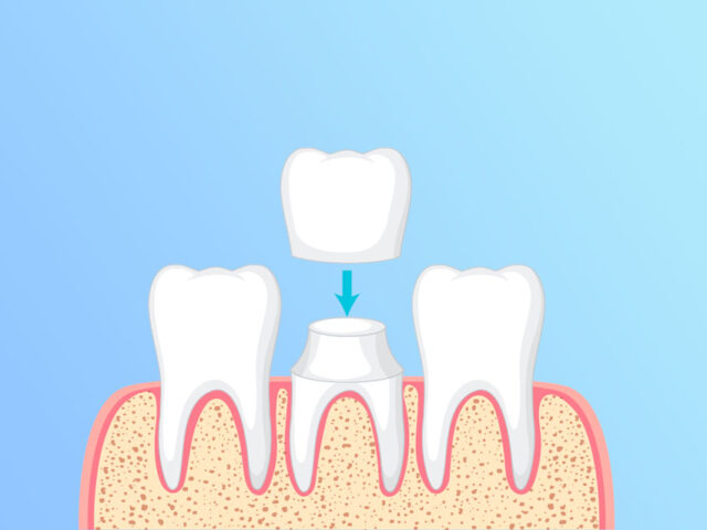 https://dentalreynosa.com/wp-content/uploads/2022/05/corona-dental-640x480.jpg